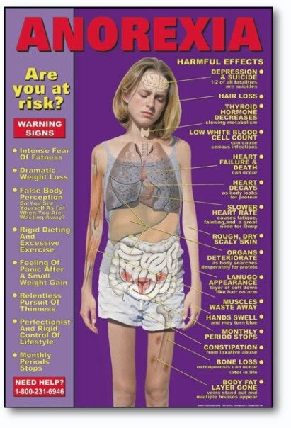bridget-anorexia-signs